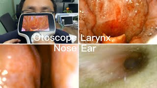 ENT Endoscopy Ear Nose Throat Examination  Using BESDATA Handheld Portable Otoscope [upl. by Regen]