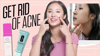 How to Remove Pimples Fast and Get Clear Skin  Acne Tips [upl. by Atnod766]