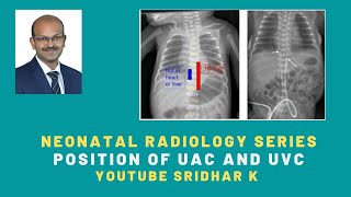 Neonatal radiology serieshow to decide position of UAC and UVC UAC UVC centralline nicu [upl. by Alexia]