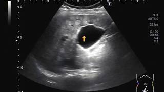 Ultrasound Video showing multiple hepatic Hemangiomas [upl. by Arda518]