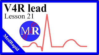 V4R in EKG [upl. by Shute]