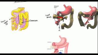 Gut Malrotation Nonrotation and Volvulus for USMLE [upl. by Zindman]