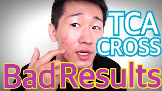 【DIY】TCA CROSS Treatments Caused Bad Results  Self Removal for Acne scarring [upl. by Abell]