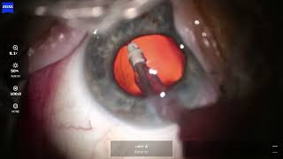 OS 2024 11 12 122440 phaco good example of almost retained cortex in moderately small pupil [upl. by Doowyah]