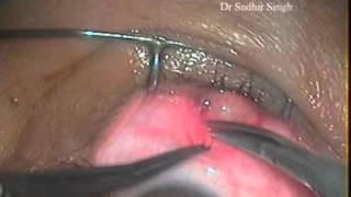 Conjunctival Cyst Excision Under Topical Anesthesia By Dr Sudhir Singh 115 [upl. by Dera]