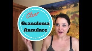 How my Granuloma Annulare Cleared Up [upl. by Lad308]