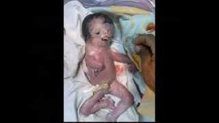 Part 1 Hesham Tillawi Depleted Uranium in Iraq Ten years after the War still causes deformed births [upl. by Edaj4]