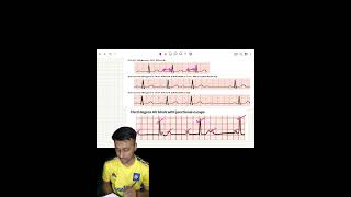 Heart block explained [upl. by Nikolos]