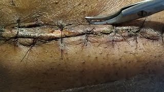 HOW TO REMOVE SURGICAL STITCHES COMPLETE PROCESS EXPLAINED drtusarofficial [upl. by Affay]