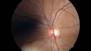 Optic Disc  Spontaneous Venous Pulsations [upl. by Nailliw674]