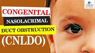 Congenital Nasolacrimal Duct Obstruction  Dr Rwituja  CNLDO [upl. by Rafiq362]