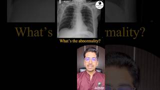 What’s the abnormality in Xray pulmonology radiology icu [upl. by Ahsenal]