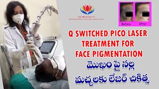 Q Switched Pico Laser treatment for Face Pigmentation [upl. by Sophy559]