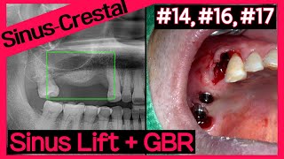 Online Surgery 16 17 OneCAS amp 14 GBR using A Oss Collagen [upl. by Lrub]