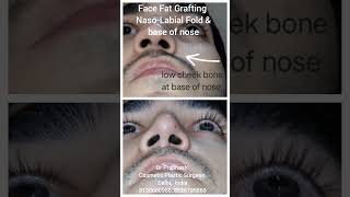 Face Nose Cheek Fat Grafting Asymmetry Correction in Delhi fatgraftingsurgery  nose  nosetip [upl. by Rufena]