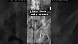 Osteoporosis Osteomalacia Pagets Disease  MedicalSurgical  Musculoskeletal  LevelUpRN [upl. by Ancier]