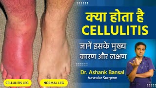 What is Cellulitis Understanding Causes Symptoms and Treatment Options with Dr Ashank Bansal [upl. by Annasiul]