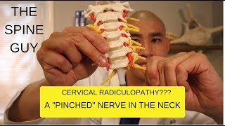 CERVICAL STENOSIS RADICULOPATHY PART 1  SYMPTOMS IMAGING AND PATIENT EXAM [upl. by Nylodam]