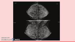 Lobular Carcinoma in Situ LCIS [upl. by Lucais]