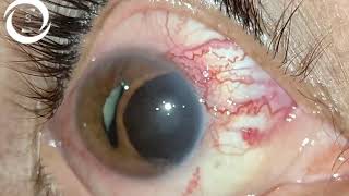 Ciliary body melanoma [upl. by Enialem]