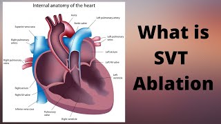 What is SVT Ablation [upl. by Adnuahs]