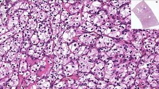 Clear Cell Renal Cell Carcinoma  Histopathology [upl. by Brok]