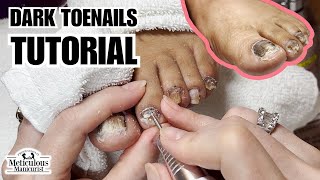 Why do Toenails turn Black nails satisfying [upl. by Notgnihsaw]