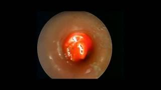 Destruction de granulome au dessus dune canule de trachéotomie par laser [upl. by Haleeuqa]