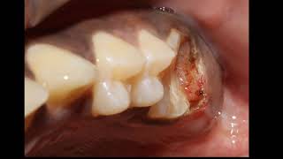 11 Subgingival caries [upl. by Jordan]