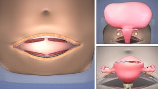 Abdominal Myomectomy through Maylard incision  TVASurg [upl. by Jaddan]