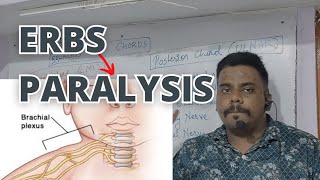 Erbs Paralysis detailed information [upl. by Inga219]