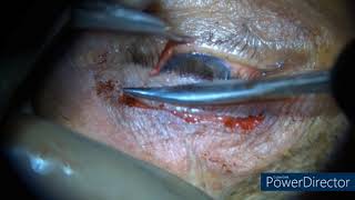 Levator Advancement for Aponeurotic Ptosis [upl. by Nelleeus]