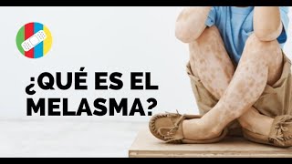 ¿QUÉ ES EL MELASMA [upl. by Waldman]