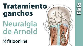 Tratamiento de fisioterapia con ganchos para la neuralgia de Arnold o neuralgia occipital [upl. by Lalla]