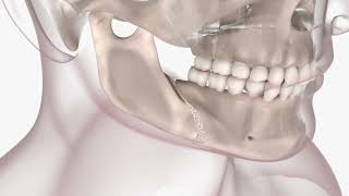 Orthognathic Surgery 3D Animation [upl. by Onnem]