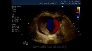 Aneurisma Disecado de la Aorta Abdominal aortic aneurysm [upl. by Ameh]