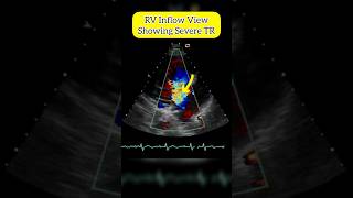 Tricuspid Regurgitation on RV Inflow view of Heart ♥ echocardiography [upl. by Eannyl]