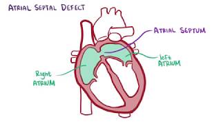 Atrial septal defect causes symptoms diagnosis treatment pathology [upl. by Lehcnom235]