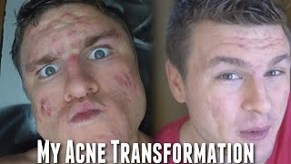 Week 54 My Acne Transformation amp Viewer Questions [upl. by Aicatsanna]