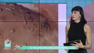 LE MALATTIE BOLLOSE AUTOIMMUNI [upl. by Iaoh]