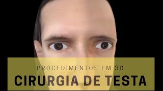 Procedimentos em 3D Cirurgia de Testa [upl. by Eedissac]