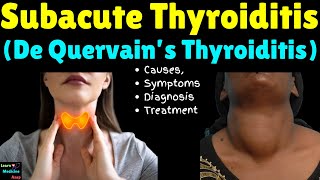 Subacute Thyroiditis De Quervain’s Thyroiditis – Causes Symptoms Diagnosis and Treatment [upl. by Neztnaj]