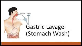 Gastric Lavage Stomach Wash [upl. by Buehler810]