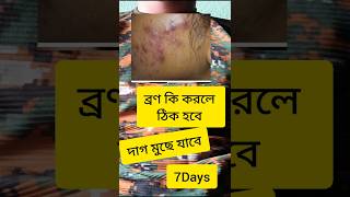 ব্রণ আছে দাগ মোছার সহজ উপায় sscgdmedical agniveer acene pimples skincare youtubeshorts [upl. by Airtal]