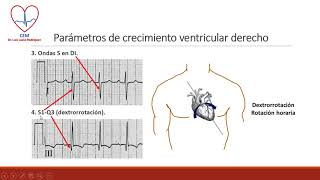 Crecimiento ventricular derecho [upl. by Eive]