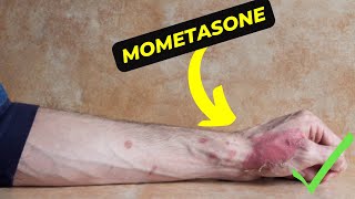 Mometasone The Ultimate Solution for Allergies and Skin Conditions [upl. by Anatnom]