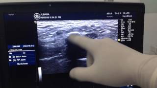 Cervical rib Dx by ultrasound [upl. by Anh827]