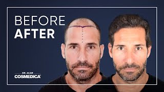 Hair transplantation in Turkey Istanbul Dr Acar  Cosmedica Clinic  Best Result [upl. by Retep]