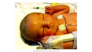 Complications in the Newborn PeriodNeonatal Jaundice  full video [upl. by Portingale]