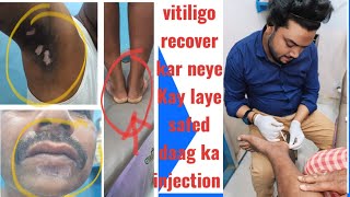 fast ⏩ vitiligo treatment  safed daag ka fast ⏩recover kar neye Kay leye injection vitiligocure [upl. by Tisha]